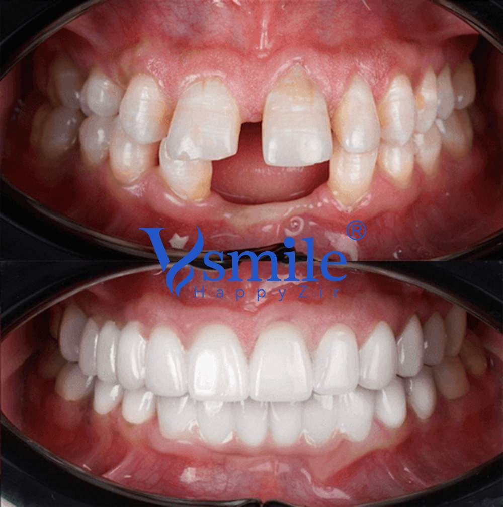 Patient Cases of vsmile Patient Cases of vsmile